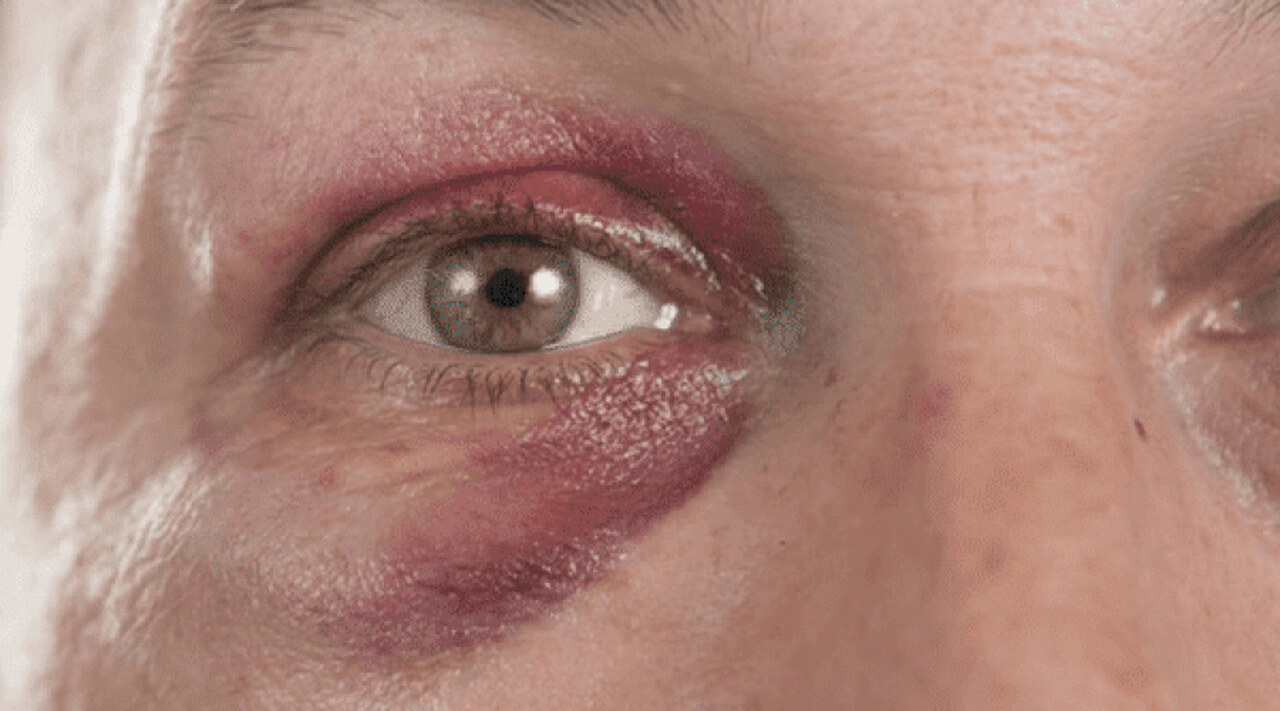 Imagem de um olho com hematomas visíveis ao redor, evidenciando um possível trauma ou contusão. A área ao redor do olho está roxa e inchada, o que é característico de um olho roxo (equimose) após um impacto ou lesão. A pálpebra inferior também mostra sinais de inflamação e coloração escura.