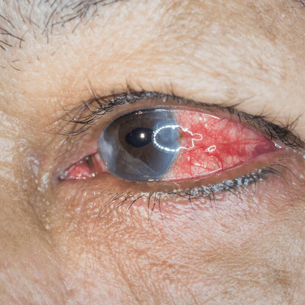 Close-up do olho de uma pessoa idosa, com sinais de inflamação visíveis, como vermelhidão ao redor da íris e da conjuntiva. O olho também apresenta uma leve opacidade no centro, sugerindo possível catarata ou outro problema ocular.