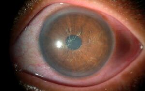 A imagem mostra um close-up detalhado de um olho humano, focando especialmente na córnea e íris. A córnea tem um aspecto turvo, possivelmente devido a uma condição ocular, como uma úlcera ou infecção. A área ao redor da córnea apresenta algumas linhas visíveis que indicam uma alteração na estrutura do olho, e a esclera (parte branca) apresenta uma leve vermelhidão. Este tipo de imagem geralmente é utilizado para ilustrar condições oftalmológicas que afetam a córnea, como ceratite ou outras infecções oculares.