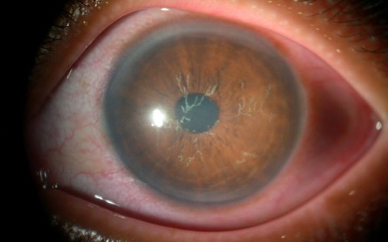 A imagem mostra um close-up detalhado de um olho humano, focando especialmente na córnea e íris. A córnea tem um aspecto turvo, possivelmente devido a uma condição ocular, como uma úlcera ou infecção. A área ao redor da córnea apresenta algumas linhas visíveis que indicam uma alteração na estrutura do olho, e a esclera (parte branca) apresenta uma leve vermelhidão. Este tipo de imagem geralmente é utilizado para ilustrar condições oftalmológicas que afetam a córnea, como ceratite ou outras infecções oculares.
