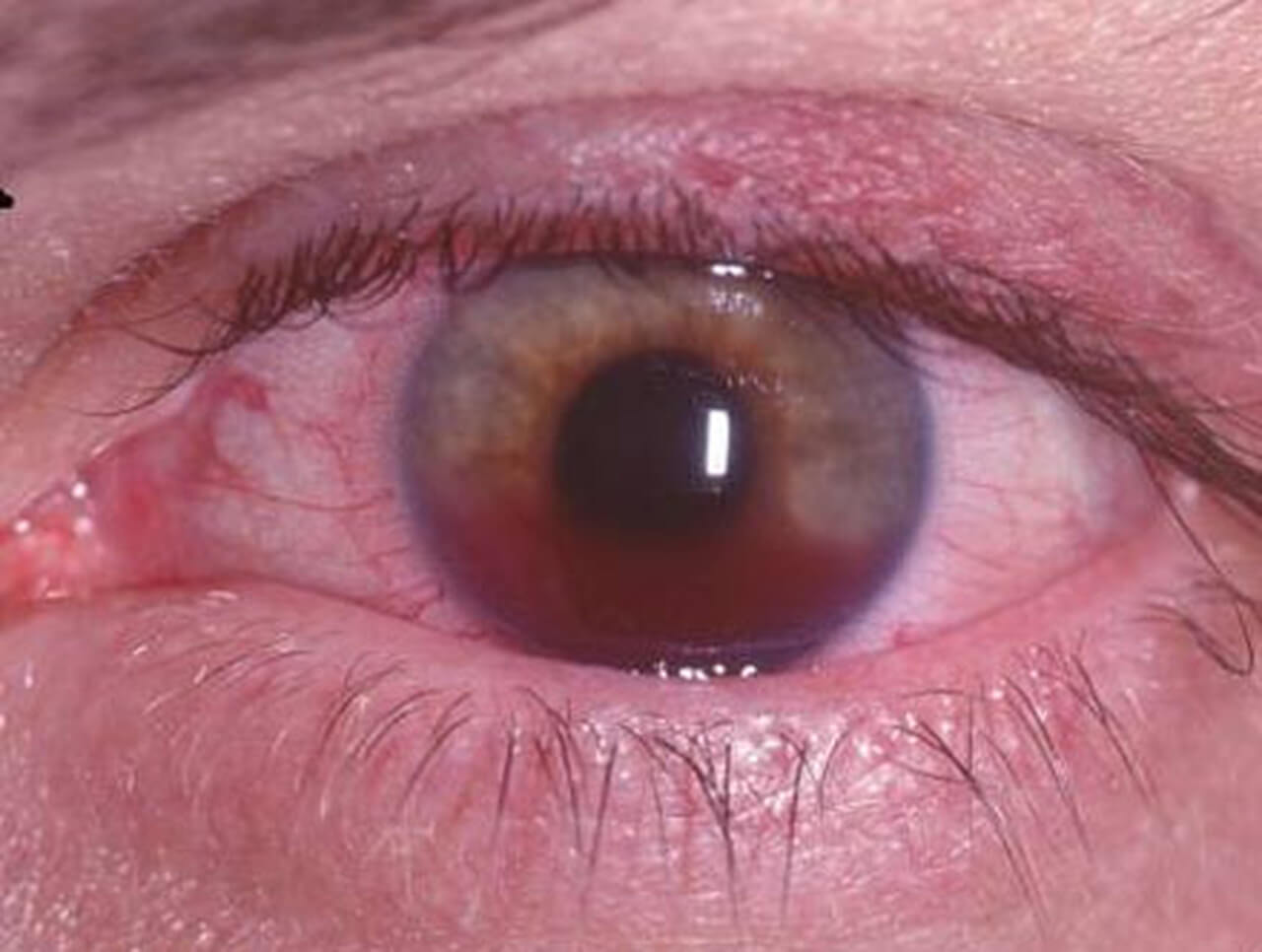 A imagem mostra um close-up de um olho humano com sinais visíveis de uma condição ocular, como uma úlcera de córnea ou outra infecção. A parte branca do olho (esclera) apresenta um tom vermelho, o que pode indicar inflamação. A íris é marrom, e a córnea parece estar afetada, com uma área mais opaca no centro. Esse tipo de condição requer atenção médica, pois pode afetar a visão e requerer tratamento oftalmológico especializado.
