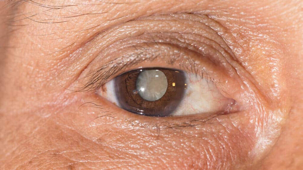 A imagem mostra um olho humano com sinais visíveis de catarata. A catarata é uma condição onde a lente do olho se torna opaca, o que pode afetar a visão. No caso desta imagem, a opacidade da lente é claramente visível, especialmente ao redor da pupila, onde a lente parece turva. A íris é de cor marrom, e o olho parece estar em estágio de desenvolvimento da catarata, que pode ser corrigido com cirurgia.
