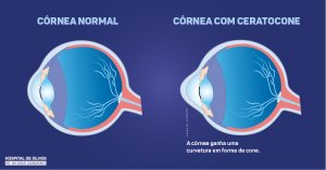 ceratocone_holhos
