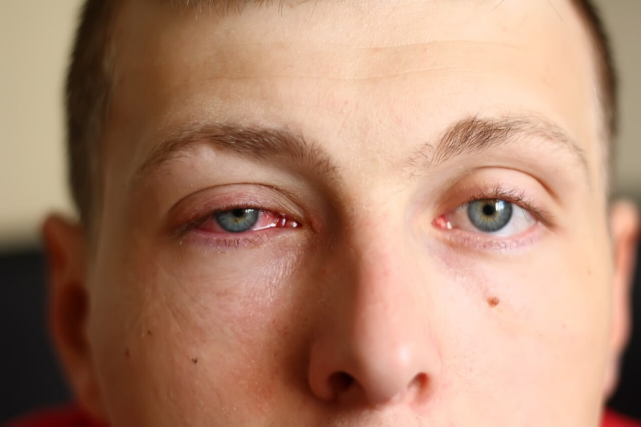 A imagem mostra o rosto de um homem com um olho visivelmente irritado. O olho esquerdo está inchado, com a pálpebra inferior mais caída, e a parte branca do olho (esclera) apresenta sinais de vermelhidão. O olho direito parece normal, com a íris azul clara. A condição visual pode ser indicativa de uma conjuntivite, infecção ocular ou alergia.
