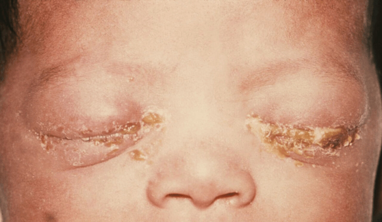 Imagem de um bebê com secreção e crostas nos olhos, um indicativo possível de conjuntivite ou outra infecção ocular. A imagem mostra os olhos parcialmente fechados, com secreção espessa nas pálpebras e na área ao redor dos olhos, o que pode sugerir a presença de infecção ou inflamação.