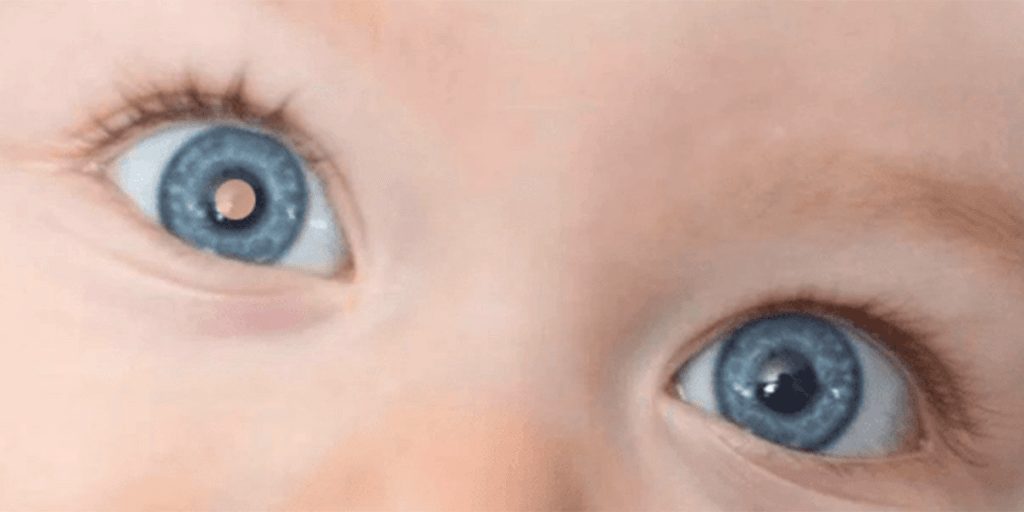 Dito pelo ChatGPT:
Close-up dos olhos de um bebê com íris azul. O olho esquerdo (à direita na imagem) apresenta um reflexo central branco, enquanto o olho direito (à esquerda na imagem) mostra um reflexo central amarelado. Essa diferença pode indicar um sinal de alerta para doenças oculares, como o retinoblastoma, sendo importante buscar avaliação médica especializada.