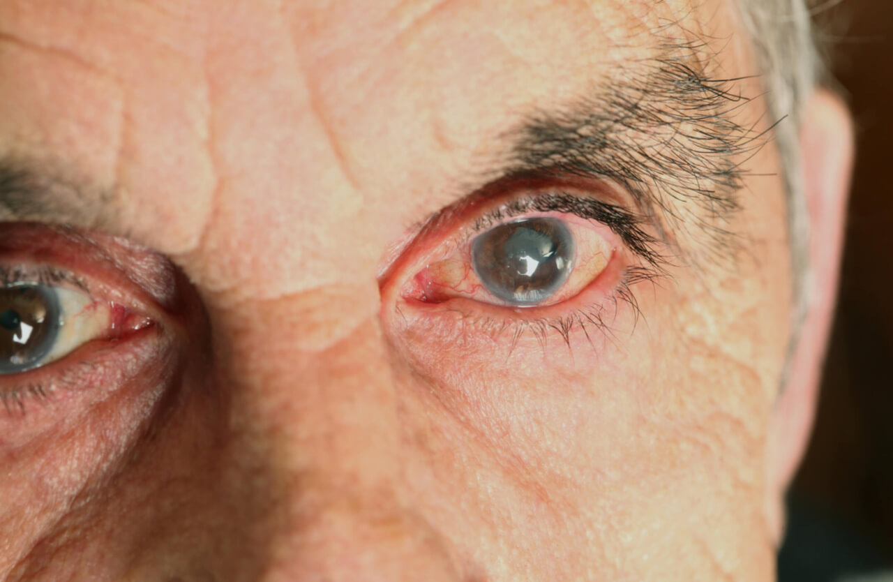 Close-up de um olho de uma pessoa idosa, mostrando sinais de catarata. O olho apresenta uma opacidade visível no centro da córnea, enquanto o restante da pele ao redor do olho está levemente enrugado e com pequenas veias visíveis.