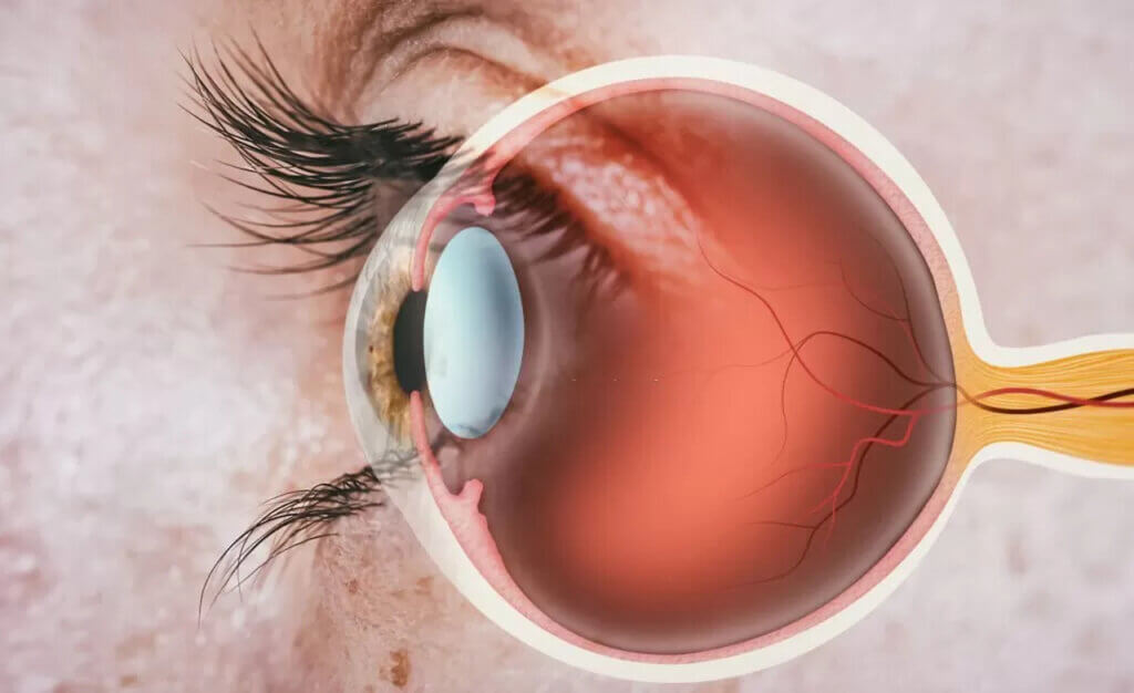 Imagem detalhada do olho humano com um corte transversal, mostrando a estrutura interna. A lente do olho está destacada, ilustrando uma condição de catarata, com uma opacidade visível na parte central da lente.