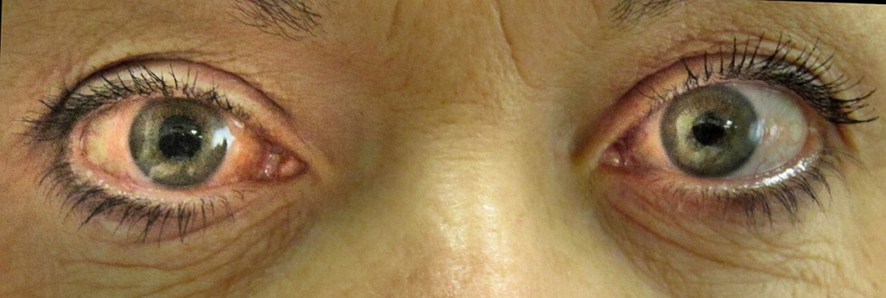 A imagem mostra um close-up de um par de olhos humanos, evidenciando uma condição ocular que pode ser caracterizada por vermelhidão na parte branca dos olhos (esclera), que pode ser indicativo de inflamação ou irritação ocular. O olhar está direcionado à câmera, e a imagem foca nos detalhes dos olhos, com uma aparência de desconforto ou condição médica, como conjuntivite ou outras irritações.
