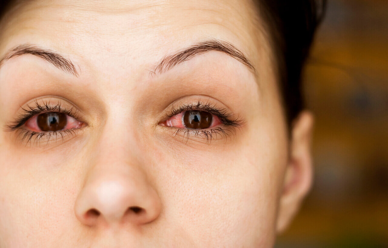 A imagem mostra uma mulher com os olhos visivelmente irritados. A parte branca dos olhos (esclera) apresenta um tom avermelhado, indicando sinais de inflamação ou irritação ocular. A mulher parece estar olhando diretamente para a câmera, com uma expressão facial séria. O fundo da imagem é desfocado, destacando o foco nos olhos da mulher. Isso pode sugerir uma condição como conjuntivite ou fadiga ocular.
