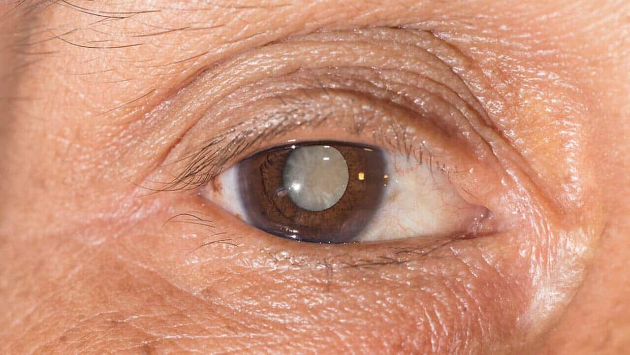 
Uma fotografia em close-up de um olho humano com uma catarata visível na pupila. O olho tem a íris marrom e a pele ao redor tem rugas finas.