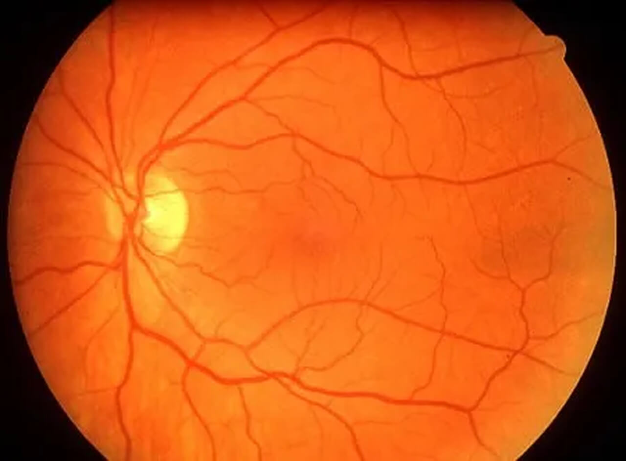 
Uma imagem médica de um fundo de olho (retina), mostrando o nervo óptico brilhante e amarelado no lado esquerdo, e uma rede de vasos sanguíneos vermelhos se espalhando sobre o fundo alaranjado da retina.