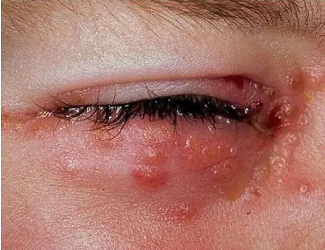 
Uma imagem em close-up de um olho com sinais de uma condição de pele, provavelmente herpes zóster oftálmico, caracterizada por lesões vesiculares e erupções vermelhas na pálpebra inferior e na área ao redor do olho. A pálpebra superior e os cílios também são visíveis.