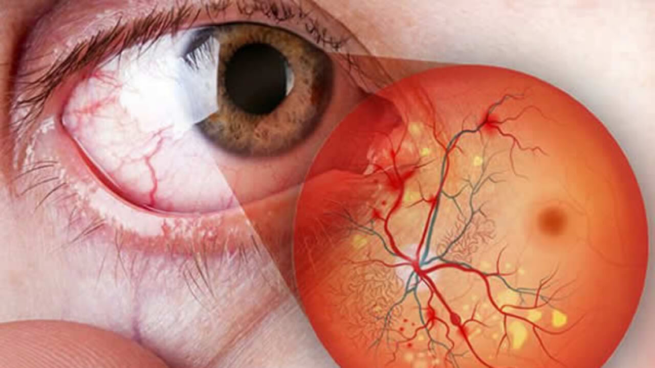 
Uma imagem composta mostrando um close-up de um olho humano com vasos sanguíneos visíveis na esclera vermelha, e uma inserção gráfica da retina. A inserção da retina mostra vasos sanguíneos ramificados e áreas de hemorragia ou dano.