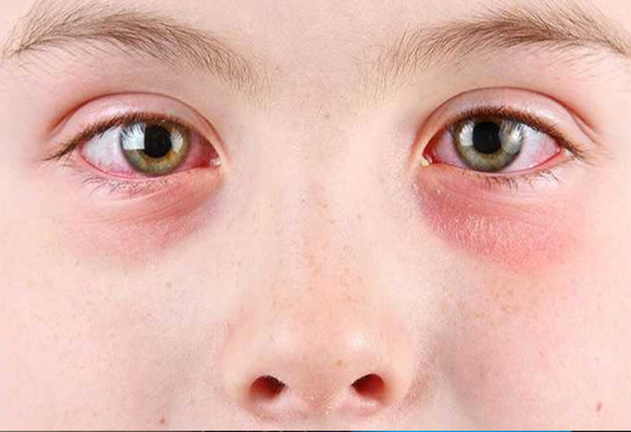 
Uma imagem em close-up do rosto de uma criança ou adolescente, focando nos olhos e na área ao redor do nariz. Ambos os olhos estão visivelmente vermelhos e inflamados, com as pálpebras inferiores inchadas e avermelhadas. As pupilas estão dilatadas e há uma leve cor marrom-esverdeada nas íris. A pele tem sardas sutis.