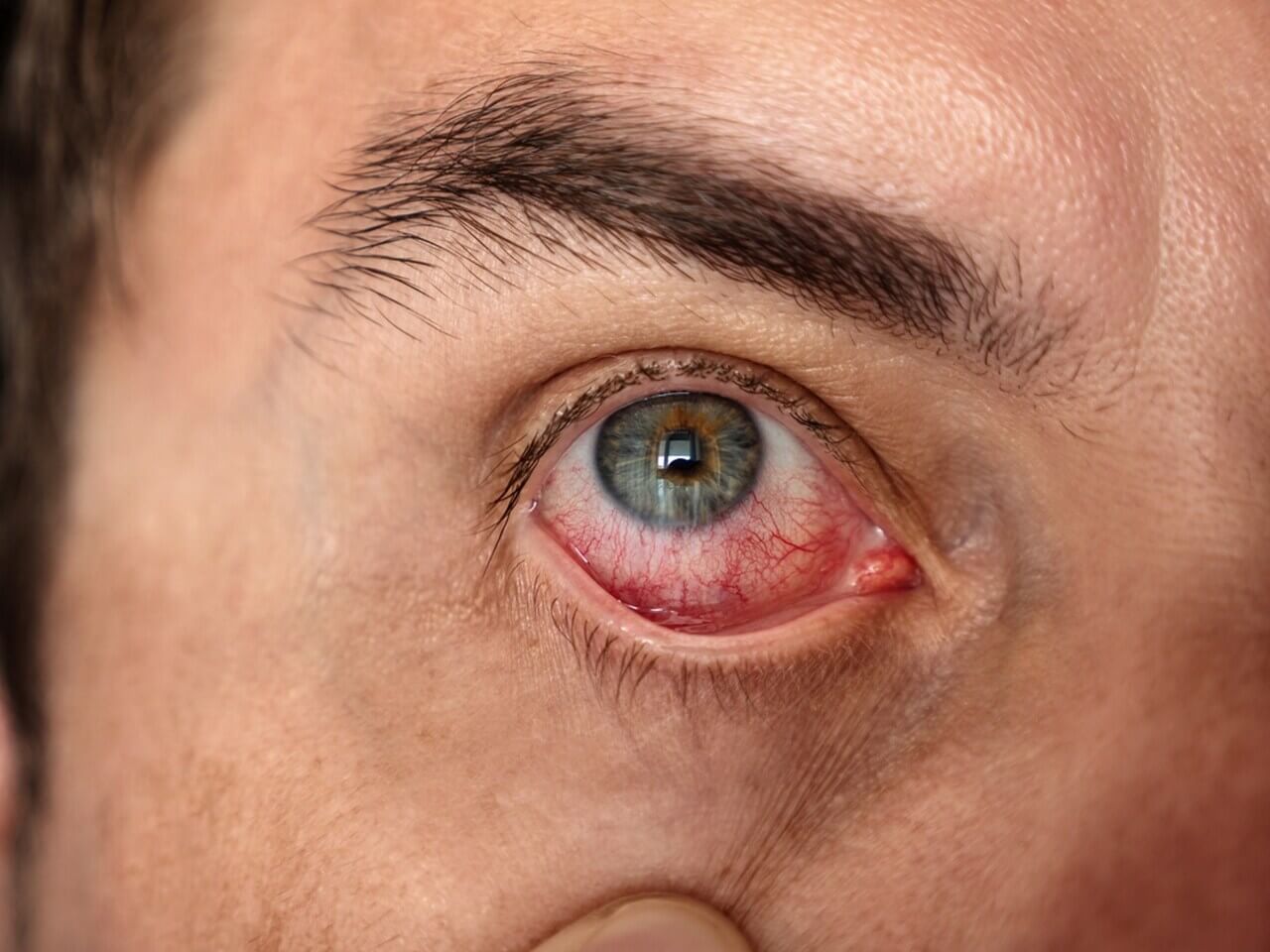 A imagem mostra um homem puxando a parte de baixo do olho para baixo e mostrando a parte vermelha do olho, o olho está vermelho e bem irritado.