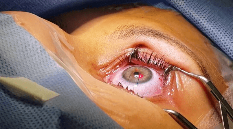 Imagem de um olho humano sendo submetido a uma cirurgia, possivelmente para correção de visão. A córnea está visível e uma ferramenta cirúrgica está sendo usada para manter o olho aberto, enquanto um laser é apontado para o centro da íris. A imagem mostra um procedimento delicado, com o uso de equipamentos estéreis e com foco na área ocular.