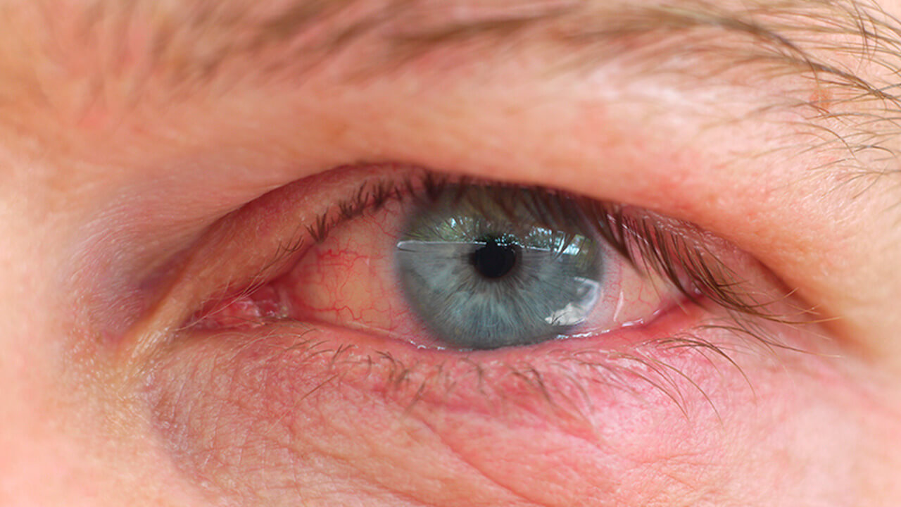 A imagem mostra um close-up de um olho, com a parte branca (esclera) ligeiramente avermelhada, indicando sinais de irritação ou inflamação. A íris é azul, e a pálpebra inferior apresenta algumas linhas vermelhas, o que pode ser um indicativo de conjuntivite, fadiga ocular ou outra condição leve que cause inflamação. O olho parece levemente desconfortável, mas a visão não está completamente obstruída.
