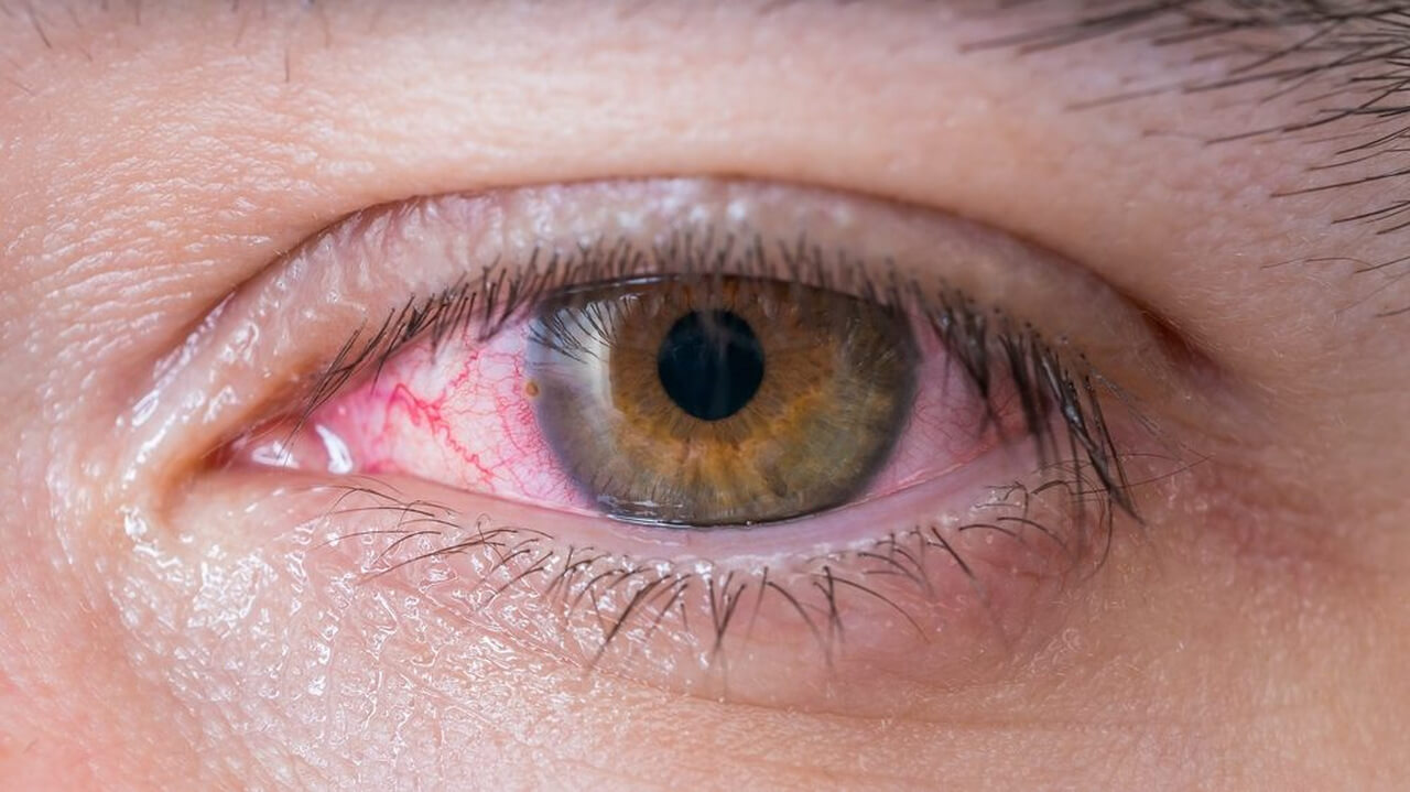 A imagem mostra um close-up de um olho com sinais visíveis de irritação. A parte branca do olho (esclera) apresenta um leve avermelhado, possivelmente devido a uma conjuntivite ou outra condição ocular que causa inflamação. A íris é de cor marrom, e o olhar está direcionado para frente.
